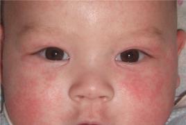 Вероятные причины покраснения и шелушения кожи при появлении красных пятен у ребенка на лице