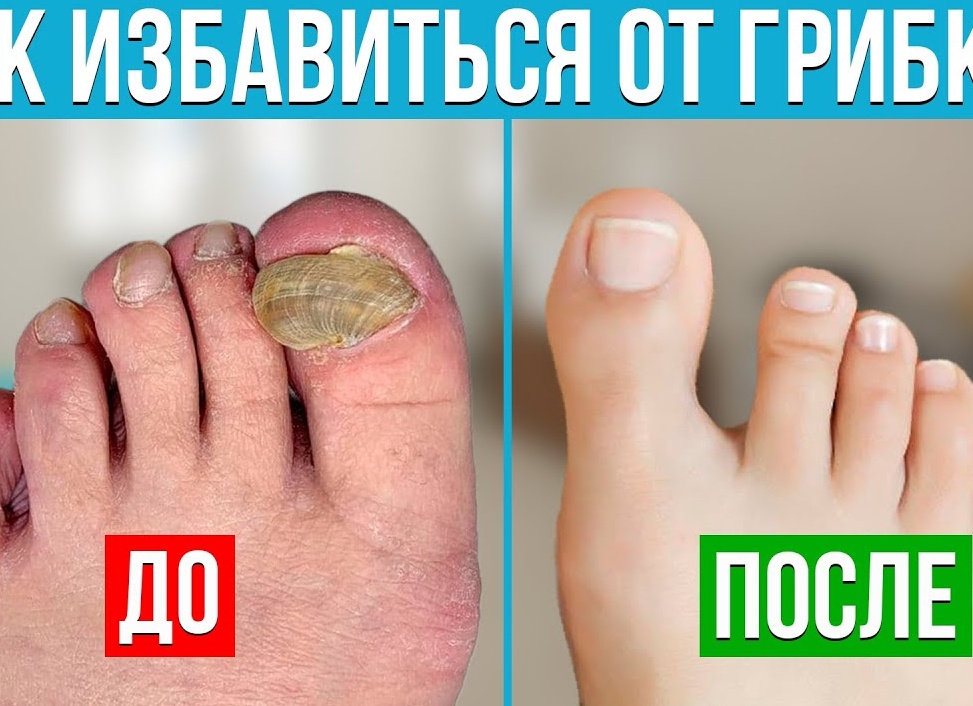 Грибок на ногтях, вылечим!