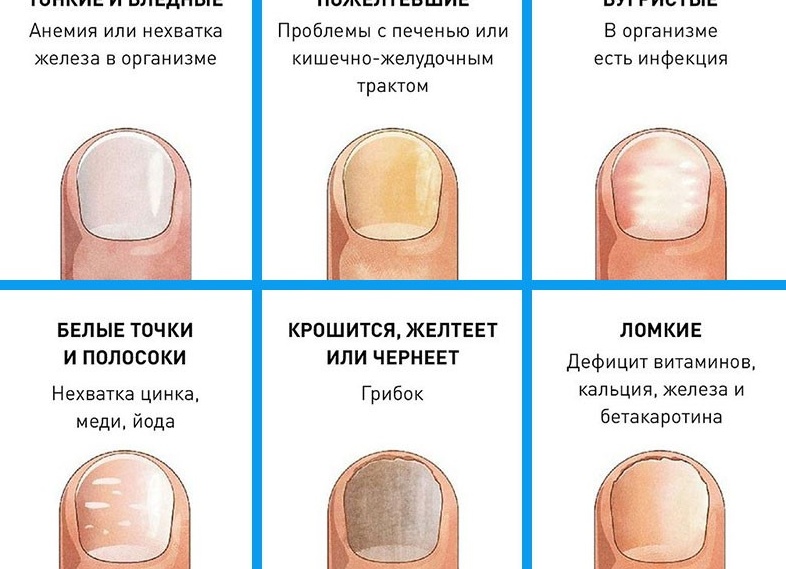 Грибок ногтей, что делать?