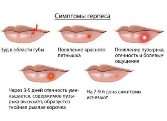 Почему на губах часто появляется герпес – когда это просто «простуда», а когда иммунодефицит