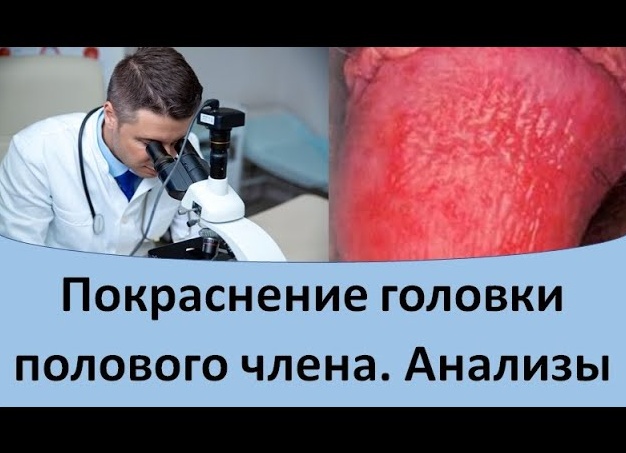 Чем вызвано покраснение крайней плоти и головки полового члена