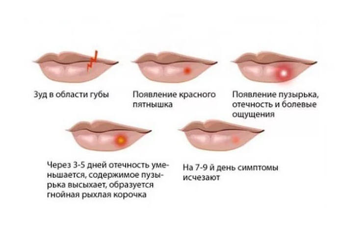 Как избавиться от герпеса