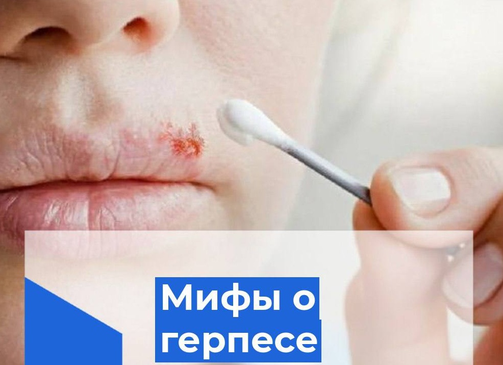 Мифы о герпесе