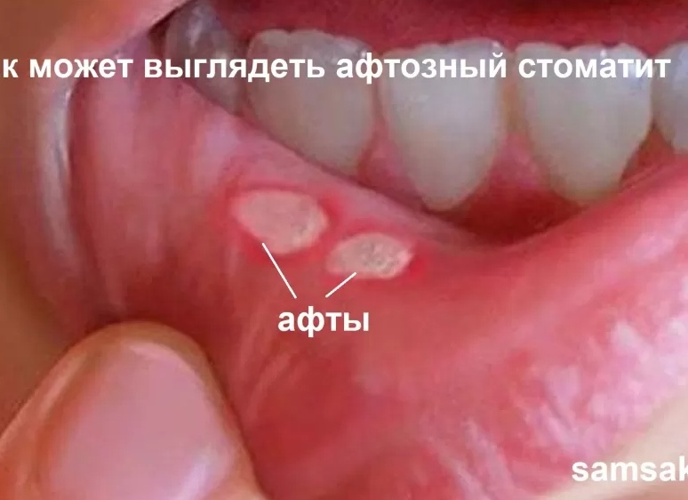 Что такое стоматит и как его предотвратить