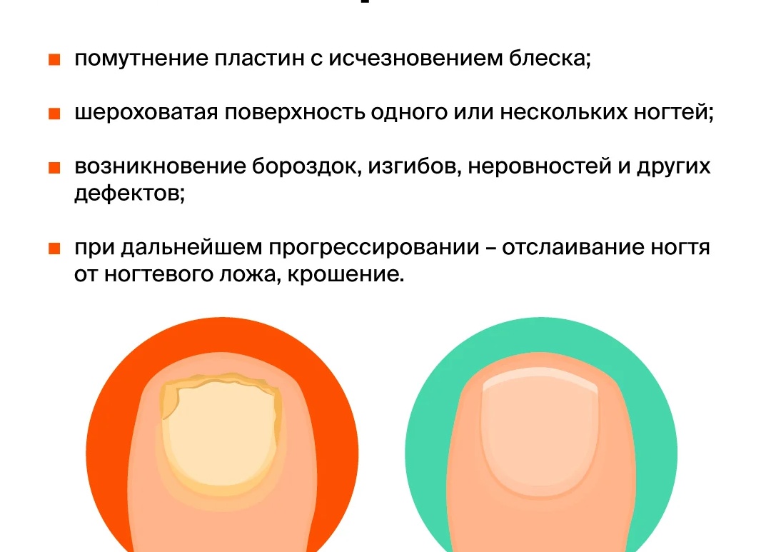 Как распознать грибок на ногах