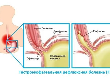Гастроэзофагеальная рефлюксная болезнь.