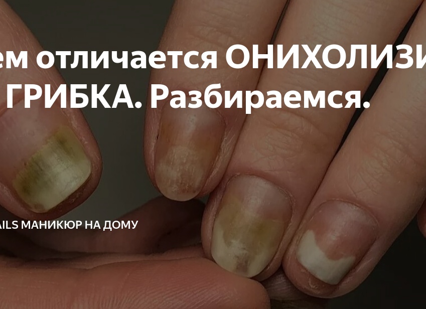 Чем отличается ОНИХОЛИЗИС от ГРИБКА. Разбираемся.