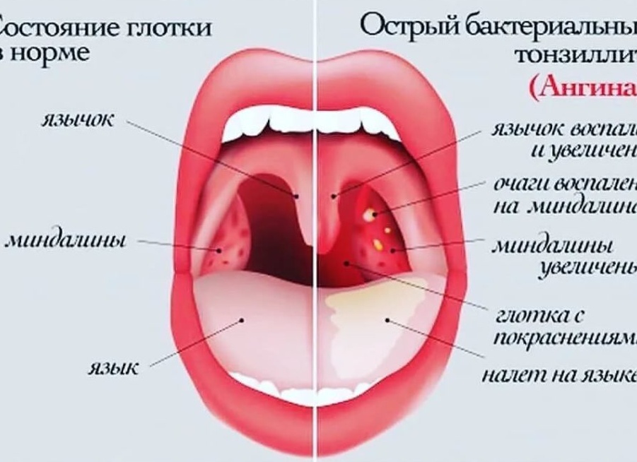Почему постоянно болит горло: неинфекционные и еще 10 причин о которых вы не догадывались