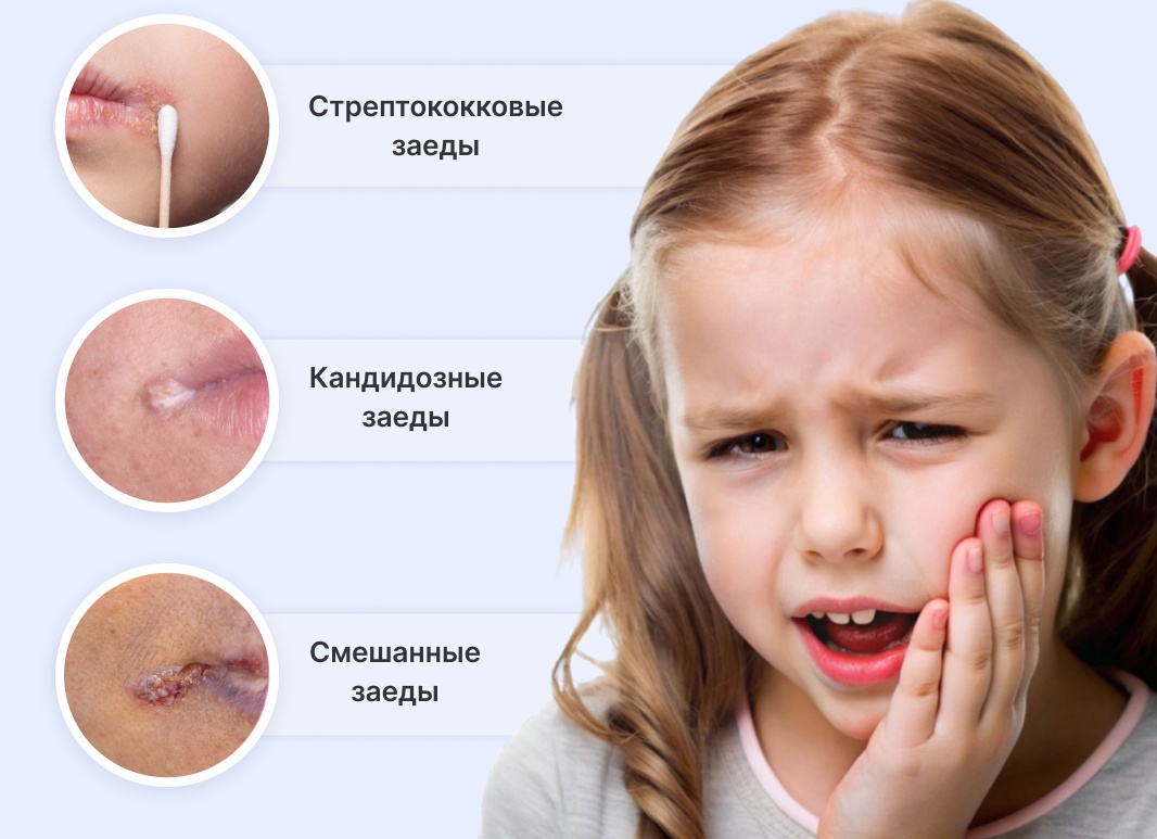 Как избавиться от заедов в уголках рта. Хейлит: причины, симптомы и лечение