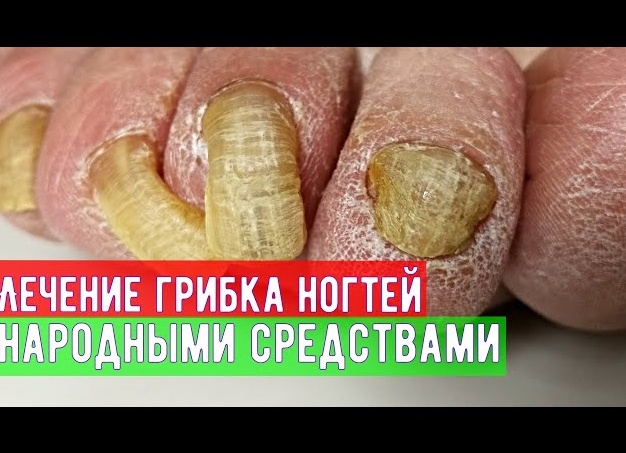 Лечение грибка ногтей народными средствами, в домашних условиях