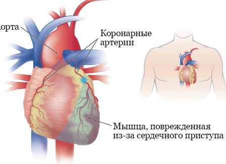 Эти таблетки могут вас убить: что нельзя принимать в жару ни в коем случае