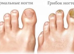 Как и где можно заразиться грибком