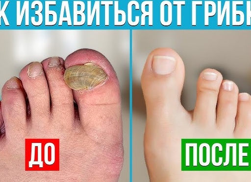 Быстрый способ избавиться от грибка