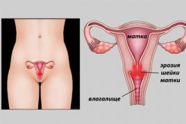 Eroziunea cervicală Ce supozitoare contraceptive sunt posibile pentru eroziune