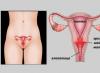Eroziunea cervicală Ce supozitoare contraceptive sunt posibile pentru eroziune