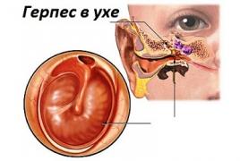 Херпес в ухото, идентифициране на симптоми и лечение Херпес в ухото може да бъде каутеризиран