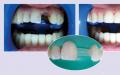 Възстановяване на зъби - възможно ли е да се възстанови зъб, преглед на цените Как да се възстановим след изваждане на зъб