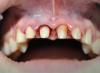 Подготовка за поставяне на корона на зъб, какво трябва да знае пациентът?