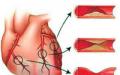 Коронарна болест на сърцето Класове на тежест на пациенти с миокарден инфаркт