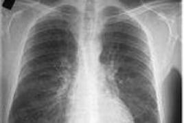 Bronhīta formas, simptomi un ārstēšana Kā izārstēt hroniska bronhīta paasinājumu