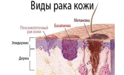 Кожен базалноклетъчен карцином (базалноклетъчен карцином) Свързани заболявания и тяхното лечение