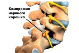 Cauze, simptome și metode de tratament pentru osteocondroza cervicală Ce este osteocondroza coloanei vertebrale
