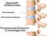 Научаваме за симптомите и лечението на остеохондрозата на шийните прешлени Какъв вид заболяване е остеохондрозата на шийните прешлени?