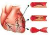 Boala coronariană Clasele de severitate ale pacienților cu infarct miocardic