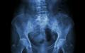 Importanța diagnosticului în timp util și precis al osteoporozei