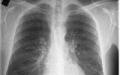 Forme, simptome și tratamentul bronșitei Cum se vindecă exacerbarea bronșitei cronice