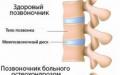 Научаваме за симптомите и лечението на остеохондрозата на шийните прешлени Какъв вид заболяване е остеохондрозата на шийните прешлени?