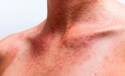 Слънчева алергия: причини, симптоми, лечение