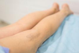 Tratamentul asteriscurilor vasculare pe picioare