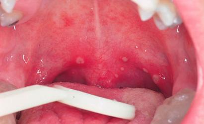 Cât de periculos este herpesul pentru adulți și copii?