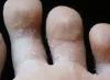 Pēdu sēnīte - sēnīšu ārstēšana uz kājām un starp pirkstiem mājas apstākļos