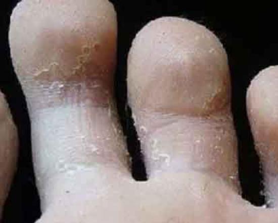 Glivice stopal - zdravljenje glivic na nogah in med prsti doma