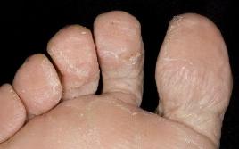 Най-често срещаните видове гъбични инфекции по краката