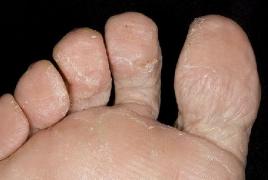 The most common types of fungal infections on the feet