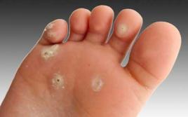 Как да излекувате сухи мазоли по пръстите на краката и стъпалото у дома?