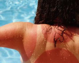 Какво да направите при слънчево изгаряне: първа помощ и лечение